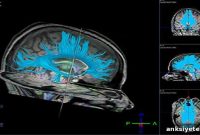 Brain Scans Explain Why Concussions Affect People Differently