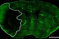 Promising Stroke Treatment May Prevent and Reduce Brain Damage