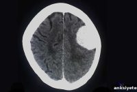 Researchers Reveal Pathway Behind Common Brain and Spinal Tumor