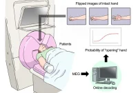 Phantom Limb Pain Relief with Brain Training