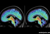 Brain Imaging Reveals Differences Linked to Autism