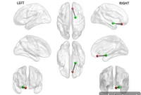 Smartphones Reveal Brain Signals Tied to Anxiety and Depression
