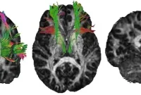 How Brain Structure Changes Affect Cognition