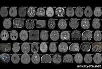 Genetic Causes of Cerebral Palsy Explained