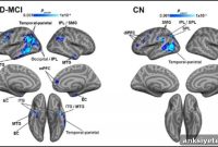 Reduced Cerebral Blood Flow Linked to Elevated Tau Protein