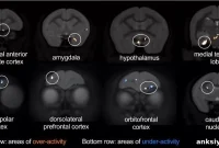 One Brain Area Links Mood, Heart Disease, and Therapy Response