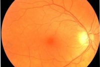 Eye Exam Could Detect Parkinson’s Disease Early