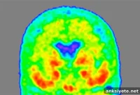 Alzheimer’s Protein in Spinal Fluid Predicts Disease Stage