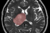 Study Links Tissue Repair Processes to Brain Cancer