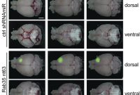Cellular Transport Pathway Linked to Aggressive Brain Tumors