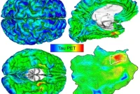 Automated Imaging Detects and Tracks Alzheimer’s Brain Protein