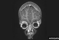 Gene Variants Raise Neuroblastoma Risk and Drive Progression