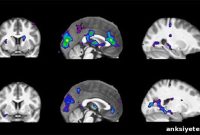 Genes Predict Brain Response to Smoking and Addiction Risk