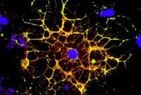 How HIV Causes White Matter Loss in the Brain