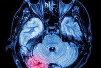 New Drug Could Prevent Dementia After Repeated Head Injuries