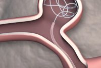First Steerable Catheter for Brain Surgery Boosts Precision