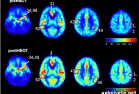 Hyperbaric Oxygen Reverses Alzheimer’s and Dementia Hallmarks