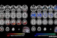 Amyloid Beta and Serotonin Predict Late-Life Depression Risk