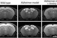 Low Protein Diets May Accelerate Dementia, Amino Acids Slow It