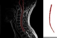 Study Links Low Vitamin D to Worse Multiple Sclerosis Symptoms