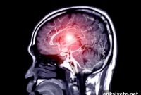 How Sodium Affects Cerebral Blood Flow