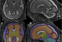 MRI Study Finds Prenatal Alcohol Exposure Alters Fetal Brain