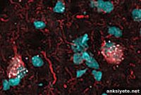 Targeting Faulty Brain Cells May Offer New Alzheimer’s Treatment