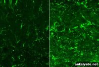 Novel Therapy Reduces Brain Damage in PSP and Alzheimer’s Mice