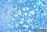 Dendritic Cell Vaccine Brings Remission in Relapsed Neuroblastoma