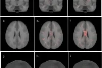 White Matter Abnormalities in Veterans After Mild TBI