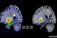 How SSRIs and CBT Change the Brain