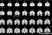 Neuroimaging Finds Brain Changes in Post-Treatment Lyme Disease