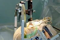 Dystonia: DBS Benefits May Persist After Device Is Turned Off