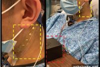 New Device Measures Nerve Activity to Treat Sepsis and PTSD