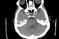 Behcet’s Disease: New Genetic Risk Factors Identified