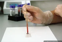 Blood Test Distinguishes Alzheimer’s Disease From Other Dementias