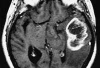 Dual Therapy Blocks Glioblastoma Escape, Kills Tumor Cells