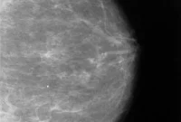 Nearly 1 in 4 Women Report PTSD After Breast Cancer Diagnosis