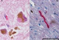 Parkin Protein Protects Neurons from Cell Death