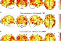 Targeting Brain Hotspots and Networks for Autism and Aggression