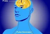 Deep Brain Stimulation Aids Treatment-Resistant Anorexia