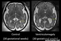 Prenatal Brain Scans Reveal Early Signs of Autism