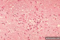 New Research Uncovers Insights into Traumatic Brain Injury