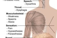 Study Finds Multiple Sclerosis More Common in African Americans