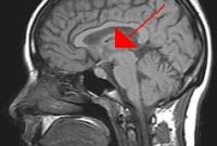 Restless Legs Syndrome, Insomnia, and Brain Chemistry Explained