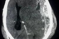 Repeated Brain Injuries Increase Suicide Risk in Soldiers