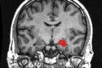 Genetic Markers Predict Postpartum Depression Risk