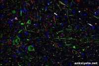 COVID-19 Could Infect Dopamine-Producing Neurons