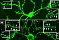 Scientists Restore Neurons Lost to Huntington’s Disease