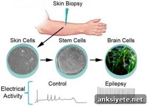 Stem Cell Models Reveal Origins and Treatment Clues for Epilepsy 2 Diagram showing the process of converting patient skin cells into induced neurons for epilepsy research.